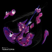 Teratoma